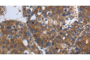 Immunohistochemistry of paraffin-embedded Human liver cancer using SOCS1 Polyclonal Antibody at dilution of 1:90