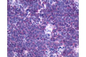 Anti-FPR3 / FPRL2 antibody IHC of human Lymph Node, Non-Hodgkins Lymphoma. (FPR3 antibody  (N-Term))
