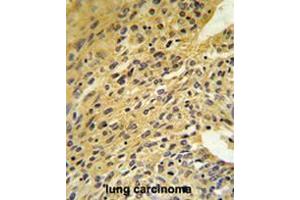 COQ5 Antibody (Center) IHC analysis in formalin fixed and paraffin embedded human lung carcinoma followed by peroxidase conjugation of the secondary antibody and DAB staining. (COQ5 antibody  (Middle Region))