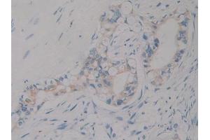 IHC-P analysis of Human Bile duct cancer Tissue, with DAB staining. (IGF1 antibody  (AA 49-118))