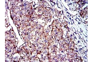 Immunohistochemical analysis of paraffin-embedded kidney cancer tissues using CD9 mouse mAb with DAB staining.