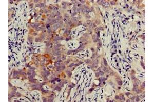 Immunohistochemistry of paraffin-embedded human pancreatic cancer using ABIN7165664 at dilution of 1:100 (JAG1 antibody  (AA 809-1046))