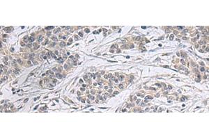 Immunohistochemistry of paraffin-embedded Human colorectal cancer tissue using PPM1K Polyclonal Antibody at dilution of 1:55(x200) (PPM1K antibody)