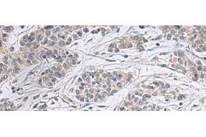Immunohistochemistry of paraffin-embedded Human colorectal cancer tissue using PPM1K Polyclonal Antibody at dilution of 1:55(x200)