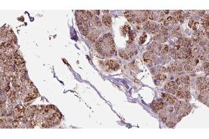 ABIN6273281 at 1/100 staining Human pancreas cancer tissue by IHC-P. (OXA1L antibody  (C-Term))