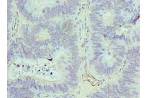 Immunohistochemistry of paraffin-embedded human colon cancer using ABIN7143847 at dilution of 1:100 (ACTR1A antibody  (AA 187-376))