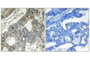 Immunohistochemistry analysis of paraffin-embedded human colon carcinoma tissue using GUF1 antibody. (GUF1 antibody)