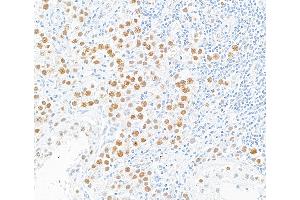 Immunohistochemistry (IHC) image for anti-MutL Homolog 1 (MLH1) (AA 450-500) antibody (ABIN7455102) (Recombinant MLH1 antibody  (AA 450-500))