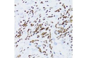 Immunohistochemistry of paraffin-embedded human gastric cancer using NFKB2 Antibody. (NFKB2 antibody  (AA 690-899))