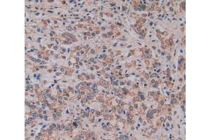 Used in DAB staining on fromalin fixed paraffin- embedded prostate gland cancer tissue (MFAP2 antibody  (AA 6-162))