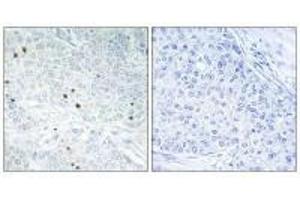 Immunohistochemistry analysis of paraffin-embedded human breast carcinoma tissue, using TP53INP2 antibody. (TP53INP2 antibody)