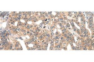 Immunohistochemistry of paraffin-embedded Human liver cancer tissue using GPR55 Polyclonal Antibody at dilution of 1:40(x200)