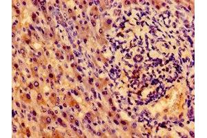 Immunohistochemistry of paraffin-embedded human liver cancer using ABIN7155192 at dilution of 1:100 (TRKA antibody  (AA 33-208))