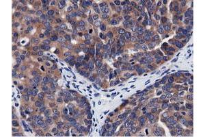 Immunohistochemical staining of paraffin-embedded Adenocarcinoma of Human breast tissue using anti-CBWD1 mouse monoclonal antibody. (CBWD1 antibody)