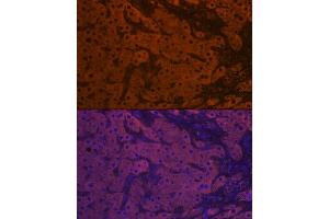 Immunofluorescence analysis of human liver cancer using ApoM Rabbit mAb (ABIN7265646) at dilution of 1:100 (40x lens). (Apolipoprotein M antibody)