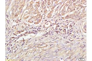 Formalin-fixed and paraffin embedded human cervical carcinoma labeled with Anti-Phospho-PKC gamma (Thr514) Polyclonal Antibody, Unconjugated (ABIN703285) at 1:200 followed by conjugation to the secondary antibody (PKC gamma antibody  (pThr514))
