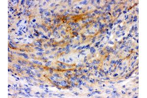Anti-GAP43 antibody, IHC(P) IHC(P): Human Meningeoma Tissue (GAP43 antibody  (C-Term))