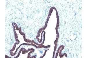 Formalin-fixed, paraffin-embedded human ovarian carcinoma stained with Cytokeratin 8 + 18 antibody (KRT8/803 + KRT18/835). (Cytokeratin 8/18 antibody)