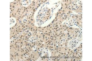 Immunohistochemistry of Human ovarian cancer using FZD10 Polyclonal Antibody at dilution of 1:50