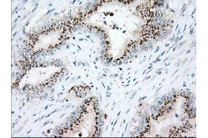 Immunohistochemical staining of paraffin-embedded Adenocarcinoma of Human colon tissue using anti-HSPA1A mouse monoclonal antibody. (HSP70 1A antibody)
