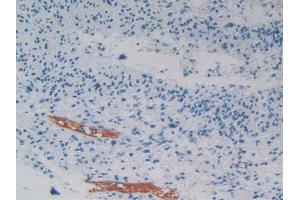 IHC-P analysis of Human Glioma Tissue, with DAB staining. (PEDF antibody  (AA 21-415))