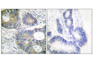Immunohistochemical analysis of paraffin-embedded human colon carcinoma tissue using 4E-BP1 (epitope around residue 64) antibody.
