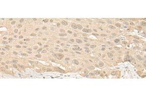 Immunohistochemistry of paraffin-embedded Human esophagus cancer tissue using IMPA1 Polyclonal Antibody at dilution of 1:25(x200) (IMPA1 antibody)