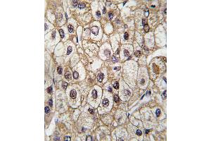 Formalin-fixed and paraffin-embedded human hepatocarcinoma tissue reacted with CYP2C9 antibody , which was peroxidase-conjugated to the secondary antibody, followed by DAB staining. (CYP2C9 antibody  (AA 235-265))