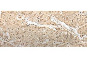 Immunohistochemistry of paraffin-embedded Human esophagus cancer tissue using ZBTB18 Polyclonal Antibody at dilution of 1:50(x200) (ZNF238 antibody)