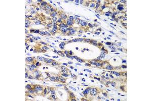Immunohistochemistry of paraffin-embedded human gastric cancer using RPN1 antibody at dilution of 1:100 (x40 lens). (RPN1 antibody)