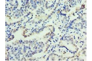 Immunohistochemistry of paraffin-embedded human lung cancer using ABIN7153128 at dilution of 1:100 (FOSL2 antibody  (AA 187-326))