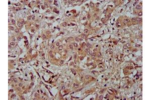 IHC image of ABIN7152919 diluted at 1:500 and staining in paraffin-embedded human liver cancer performed on a Leica BondTM system. (FBLN2 antibody  (AA 301-440))