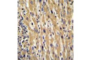 Immunohistochemistry analysis in formalin fixed and paraffin embedded human hepatocarcinoma reacted with Galanin Antibody (Center) followed by peroxidase conjugation of the secondary antibody and DAB staining.