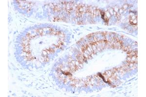 Formalin-fixed, paraffin-embedded human Colon Carcinoma stained with MUC2 Mouse Monoclonal Antibody (MLP/842). (MUC2 antibody)