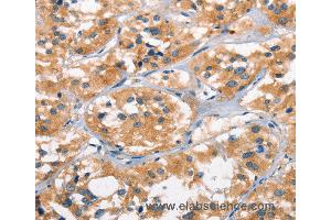 Immunohistochemistry of Human cervical cancer using AHR Polyclonal Antibody at dilution of 1:50 (Aryl Hydrocarbon Receptor antibody)