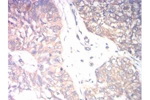 Immunohistochemical analysis of paraffin-embedded bladder cancer tissues using CD131 mouse mAb with DAB staining. (CD131 antibody  (AA 17-149))