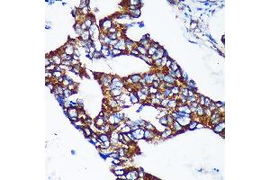 Immunohistochemistry of paraffin-embedded Human colon carcinoma using EPN2 Rabbit pAb (ABIN7267002) at dilution of 1:100 (40x lens). (Epsin 2 antibody  (AA 120-300))