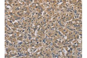 The image on the left is immunohistochemistry of paraffin-embedded Human thyroid cancer tissue using ABIN7128303(AGTRAP Antibody) at dilution 1/40, on the right is treated with fusion protein. (AGTRAP antibody)