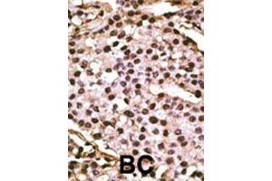 Formalin-fixed and paraffin-embedded human cancer tissue reacted with the primary antibody, which was peroxidase-conjugated to the secondary antibody, followed by DAB staining. (ATG9A antibody  (C-Term))