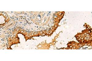 Immunohistochemistry of paraffin-embedded Human prost ate cancer tissue using PDCL Polyclonal Antibody at dilution of 1:40(x200) (Phosducin-Like antibody)