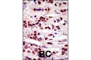 Formalin-fixed and paraffin-embedded human cancer tissue reacted with the primary antibody, which was peroxidase-conjugated to the secondary antibody, followed by AEC staining. (DRAK2 antibody  (C-Term))
