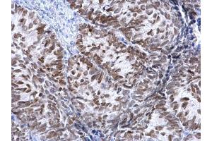 IHC-P Image FOXA1 antibody detects FOXA1 protein at nucleus on human cervical carcinoma by immunohistochemical analysis. (FOXA1 antibody  (C-Term))
