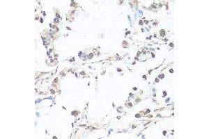Immunohistochemistry of paraffin-embedded human gastric cancer using CASP3 antibody. (Caspase 3 antibody  (AA 55-160))