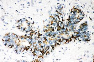 Anti- ABCB4 Picoband antibody, IHC(P) IHC(P): Human Mammary Cancer Tissue (ABCB4 antibody  (AA 601-720))