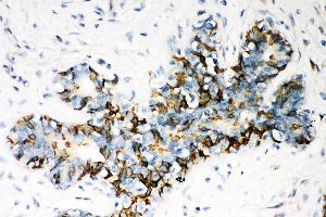 Anti- ABCB4 Picoband antibody, IHC(P) IHC(P): Human Mammary Cancer Tissue