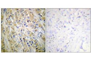 Immunohistochemical analysis of paraffin-embedded human prostate carcinoma tissue using Prostate-specific Antigen antibody (ABIN5976496).