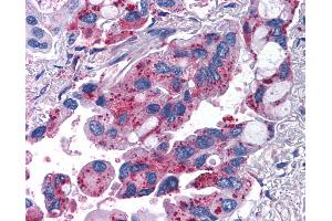 Anti-MRGPRX2 / MRGX2 antibody IHC of human Lung, Non-Small Cell Carcinoma. (MRGPRX2 antibody  (Extracellular Domain))