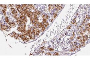 ABIN6278491 at 1/100 staining Human liver cancer tissue by IHC-P.