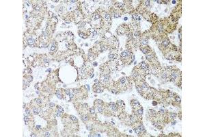 Immunohistochemistry of paraffin-embedded Human liver damage using TSG101 Polyclonal Antibody at dilution of 1:100 (40x lens). (TSG101 antibody)