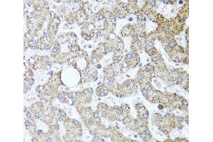Immunohistochemistry of paraffin-embedded Human liver damage using TSG101 Polyclonal Antibody at dilution of 1:100 (40x lens). (TSG101 antibody)